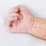 Cirebon Tetapkan Status KLB Campak Lebih Awal, 2 Balita Meninggal dan Kasus Melonjak