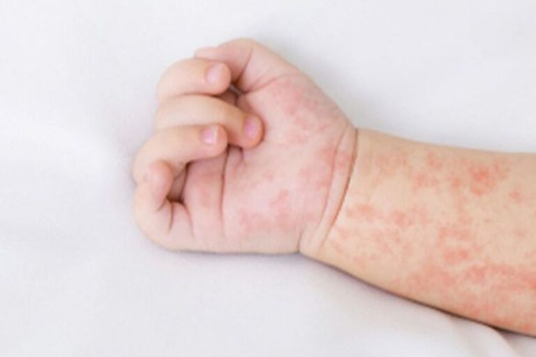 Cirebon Tetapkan Status KLB Campak Lebih Awal, 2 Balita Meninggal dan Kasus Melonjak